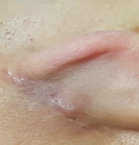  귀 뒤 멍울 피지낭종 원인과 치료 및 예방법