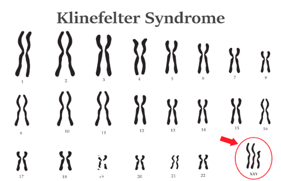 클라인펠터 증후군이 있는 남자에게 여분의 X염색체가 존재하고 있는 이미지