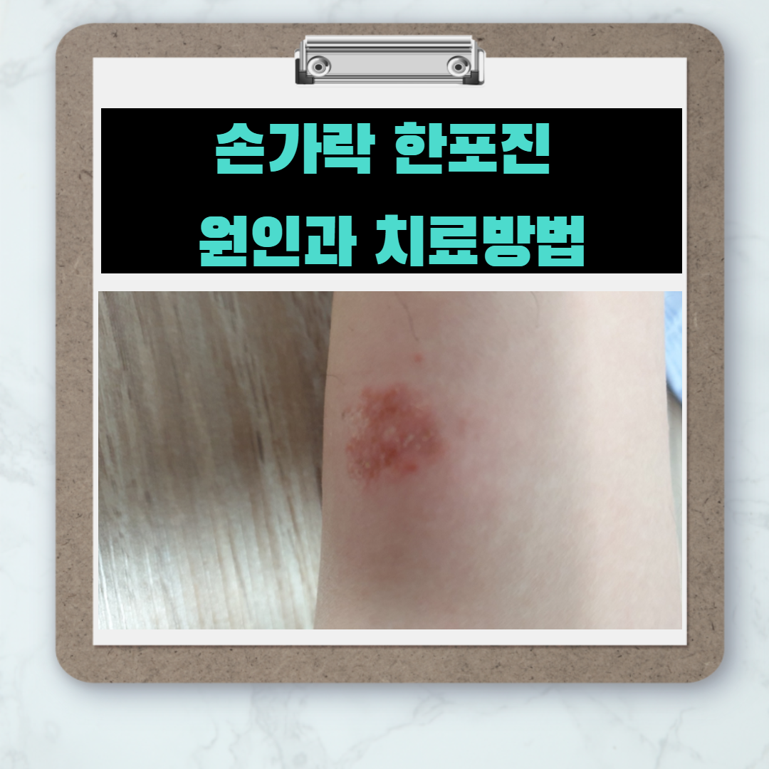  손가락,발가락에 생기는 물집 -한포진 원인 및 치료방법