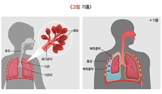  기흉