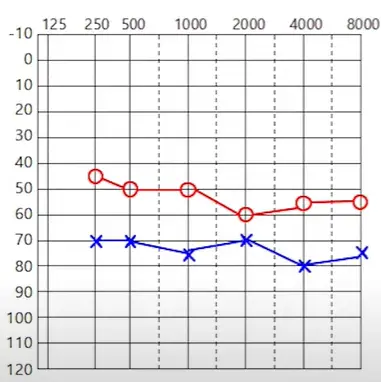 청력검사결과 그래프 플랫형