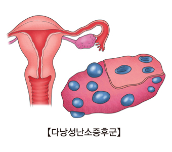 다낭성 난소증후군 사진