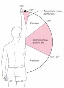 견관절의 통증 아크를 나타내는 그림