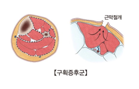 김사부3 구획증후군