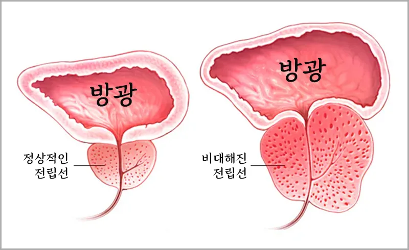 정삭적인 전립선과 비대해진 전립선