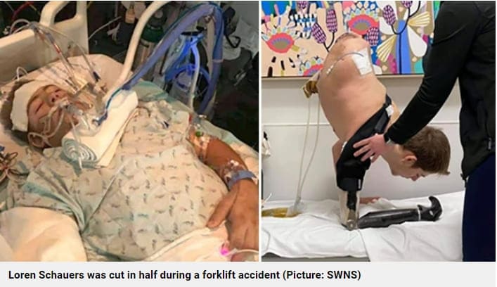  불굴의 의지로 살아가는 사람들...절대 용기를 잃지 마세요! VIDEO: Man cut in half by forklift begged doctor to save him even if he was just a head