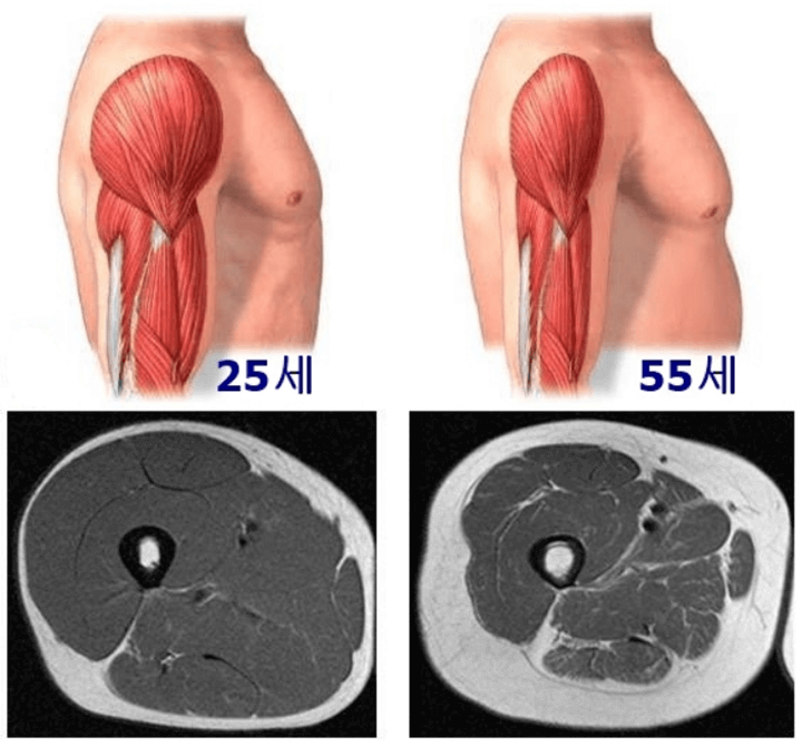 25세-55세-근육량-비교-사진