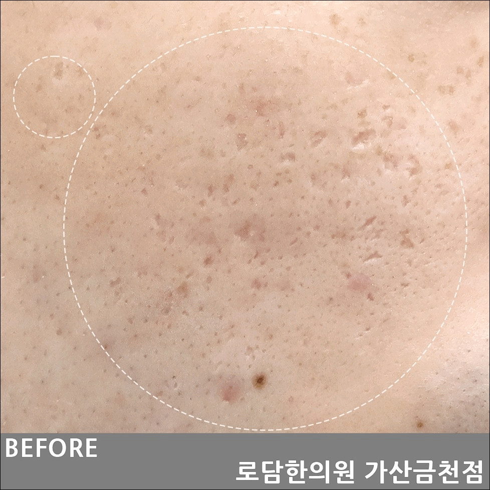  부천 여드름 파인 흉터 제거 새살침 치료 과정