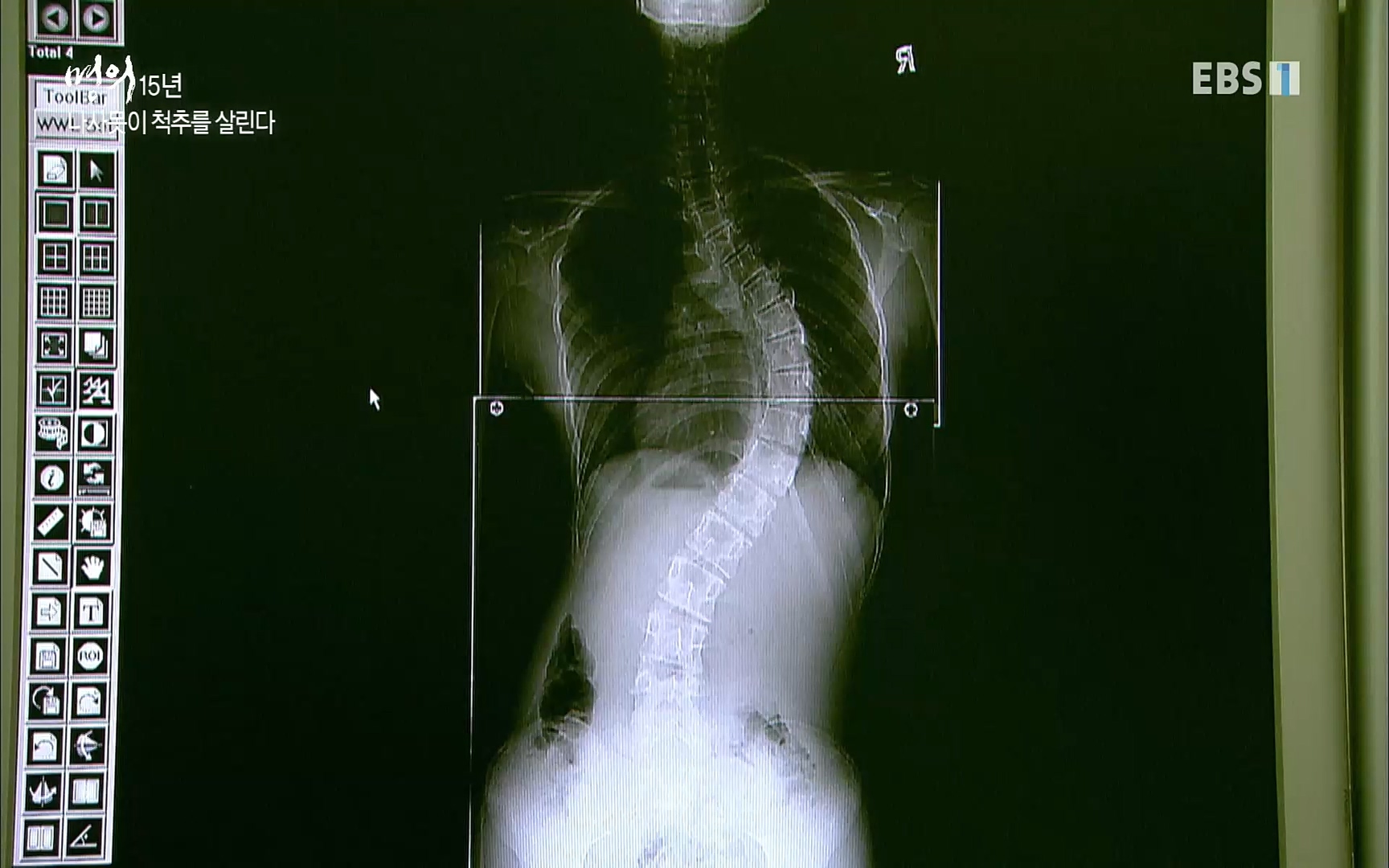 EBS 명의 헬스케어 - TV - 교육의 중심 EBS명의 15년 - 허리통증을 잡아라!.mp4_20220805_210254.040.jpg