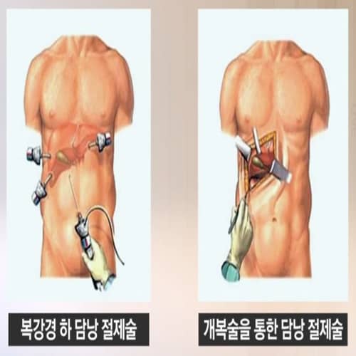 복강경 담낭 절제술 & 개복 담낭 절제술