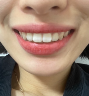 앞니 부분 교정 후기 및 비포 애프터(부분 교정 기간, 앞니 부분 교정이란?, 내돈내산 최종후기)