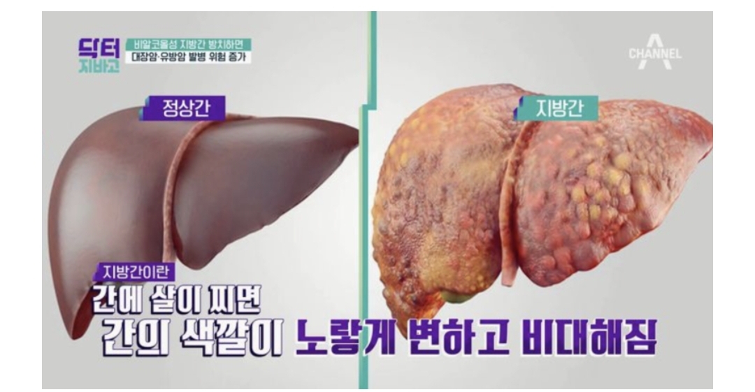  비알콜성 지방간 없애는 방법 알려드림