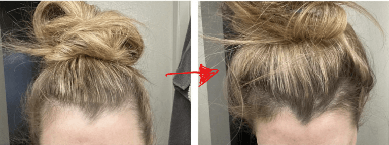 minoxidil_treatment