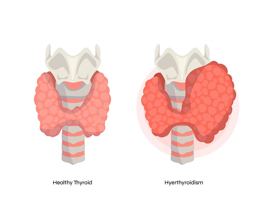 hypothyroidism