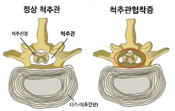 척추관 협착증 상태