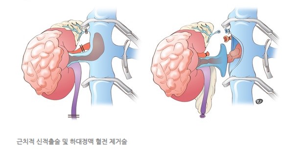 신동맥 색전술