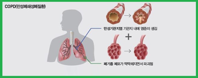 만성 폐쇄성 폐질환(COPD) 증상과 치료, 관리법