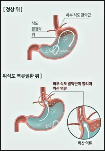 역류성 식도염 원인 초기증상 예방하는 방법_20