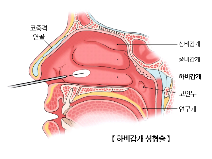  비갑개의 비후 / 치료법, 하비갑개 성형술, 코블레이터 수술