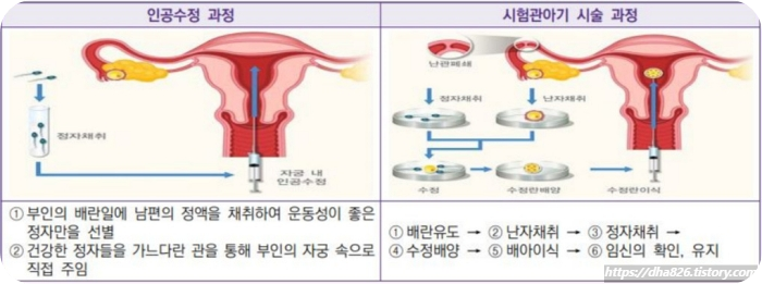 난임시술 방법