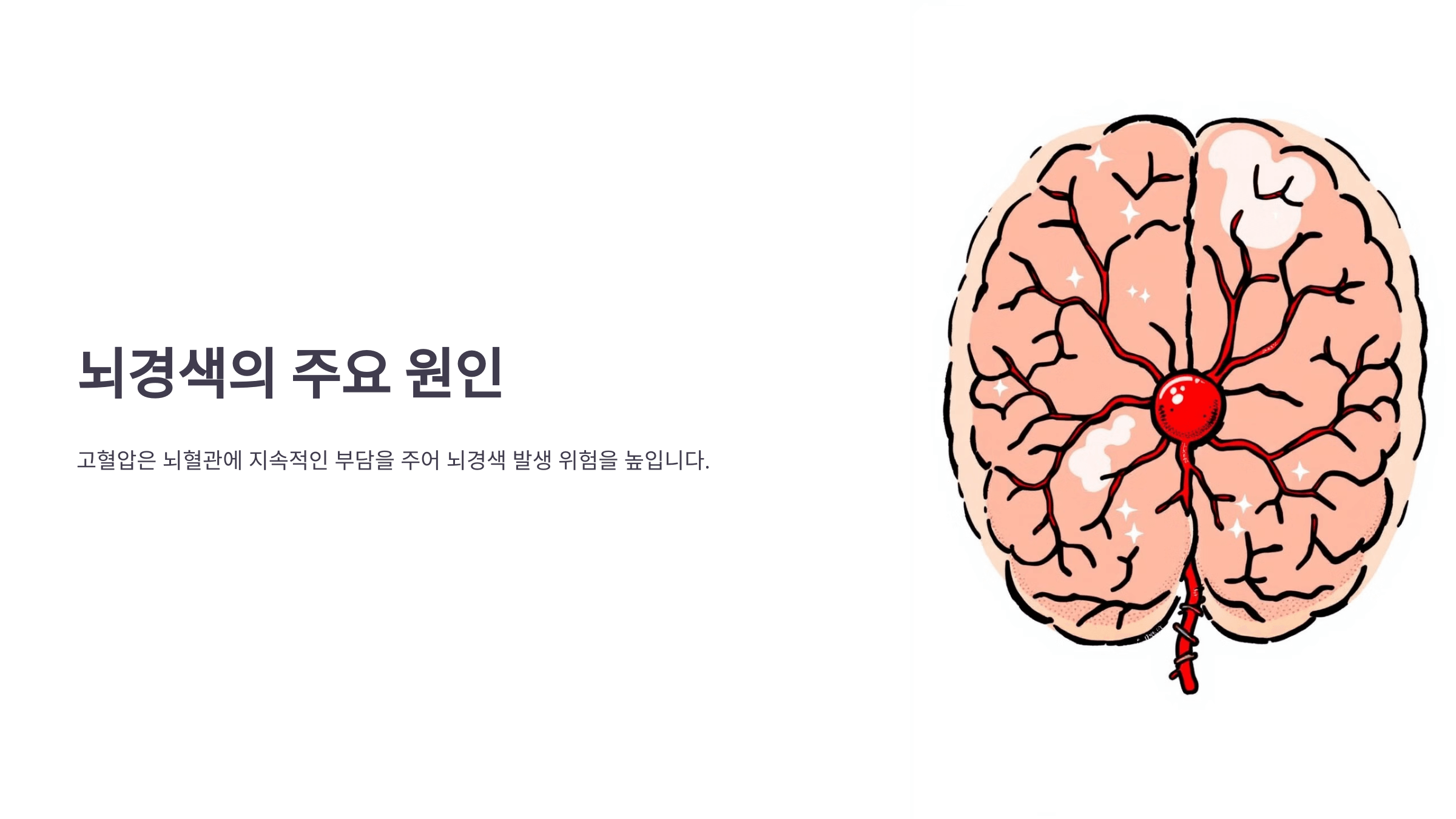 뇌경색과 관련된 사진입니다.