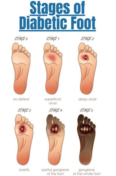 당뇨발 단계(출처 : Pinterest)