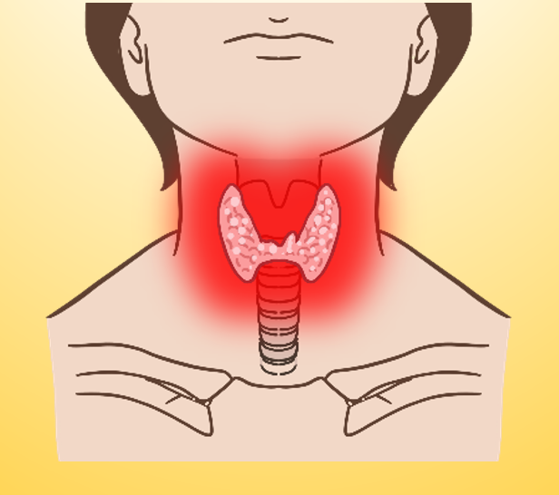 갑상선 기능 항진증 증상, 원인, 구강내과의사가 완벽정리