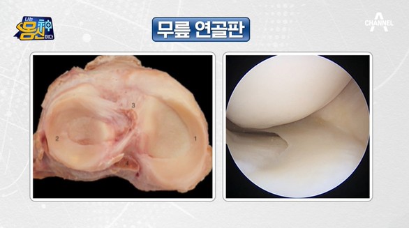 연골판