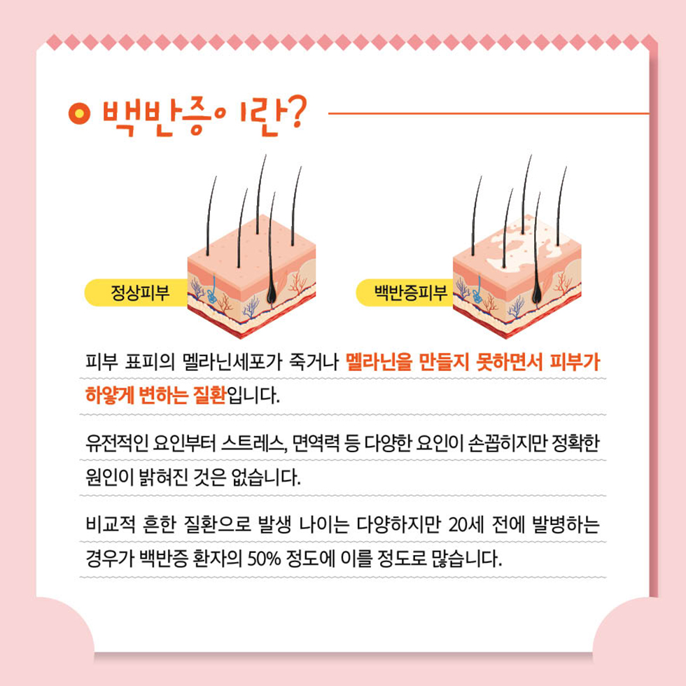  백반증이 발에 미치는 영향