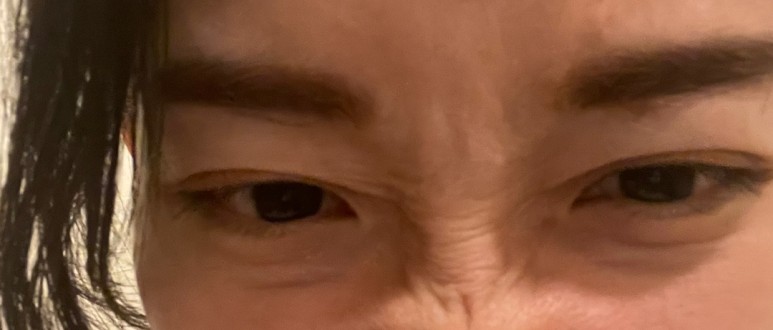제오민 보톡스 내성없는 제오민 보톡스로 콧등, 7