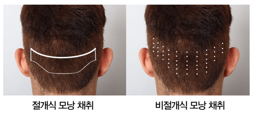 모발이식 비용 가격 모발이식 병원 추천