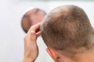 adult-male-having-balding-problems