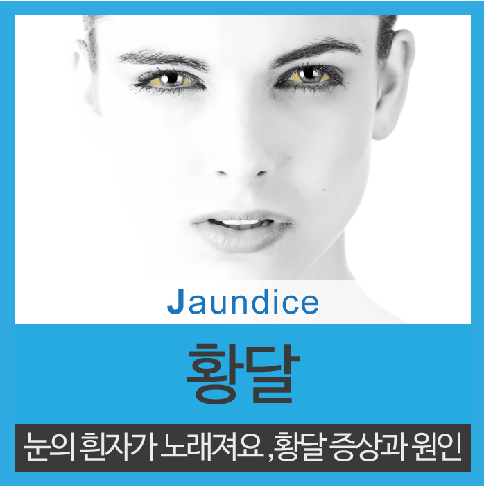  황달증상 미리미리 기억해주세요