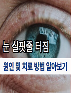  눈 실핏줄 터짐 원인 및 치료 방법 빠르게 확인하기