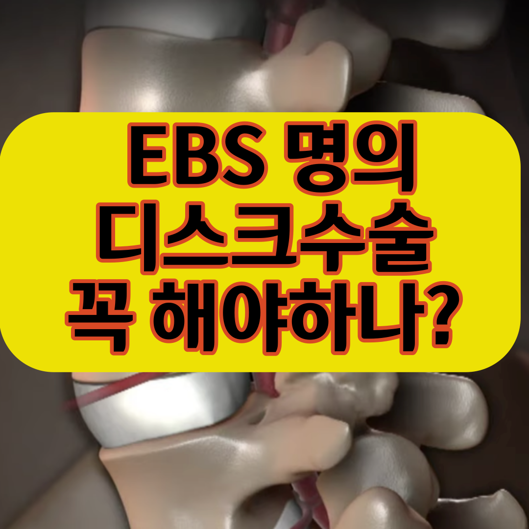  EBS 명의 디스크 수술 꼭 해야할까? 신병준 교수의 이야기는?