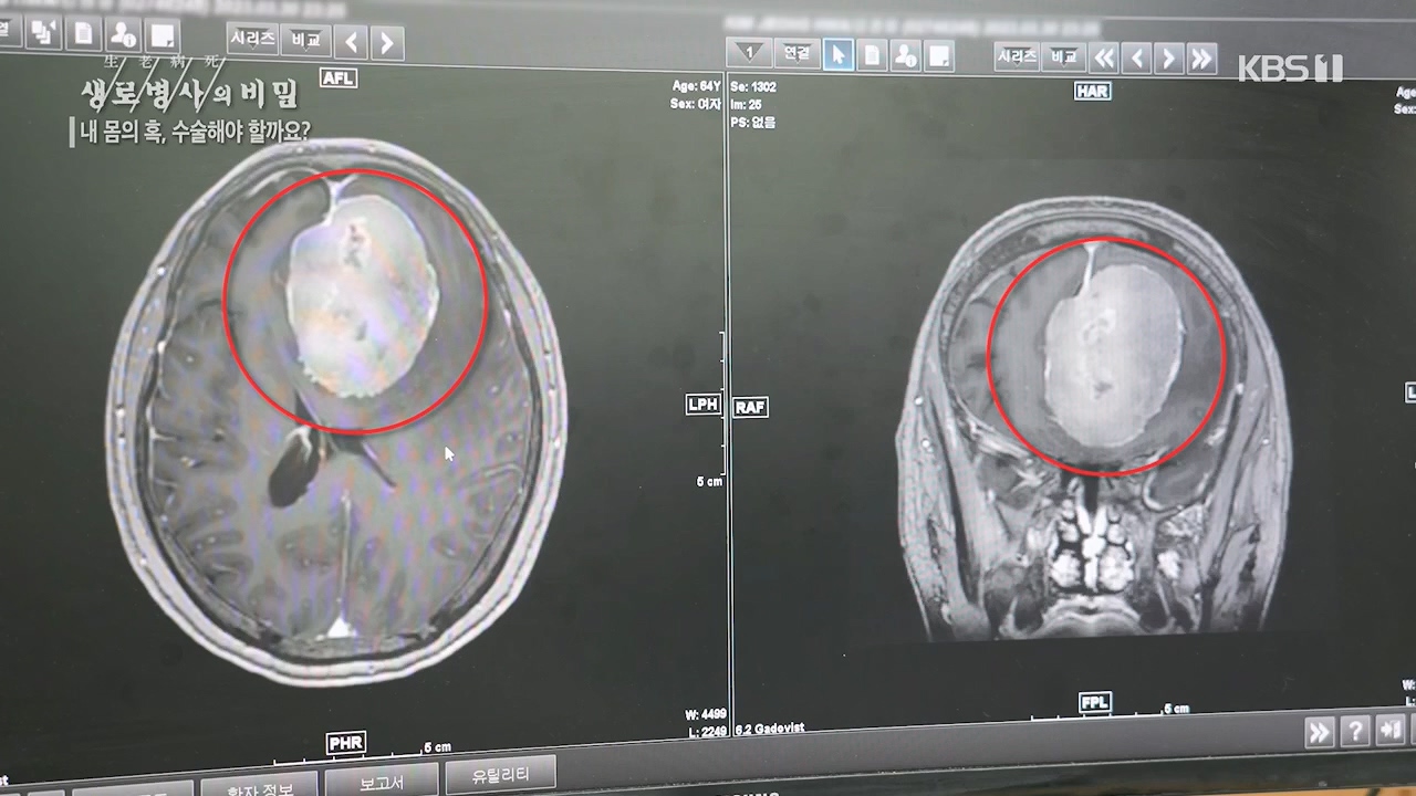 생로병사의 비밀.E870.230532p.H264-F1RST.mp4_20230605_201520.418.jpg