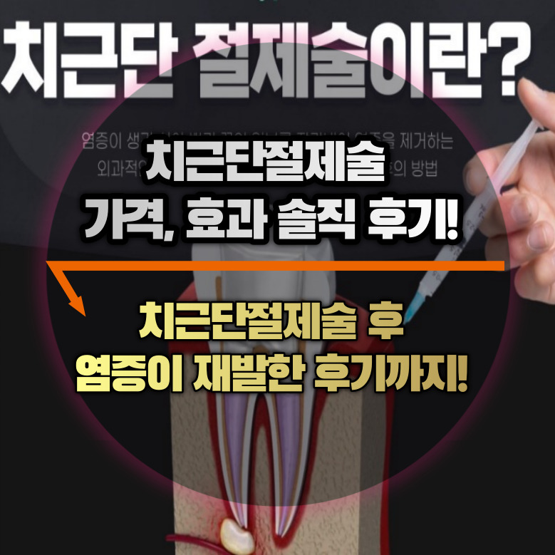 치근단 절제술
