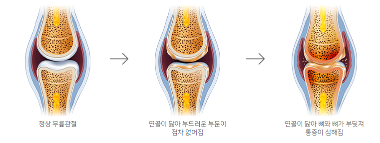 퇴행성-관절염-진행과정