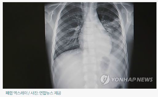 환절기폐렴_연합뉴스