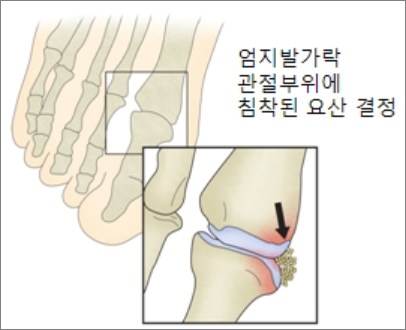 통풍성 관절염