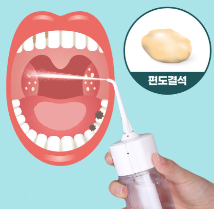 편도결석