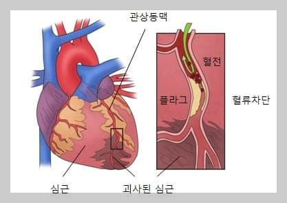 심근경색