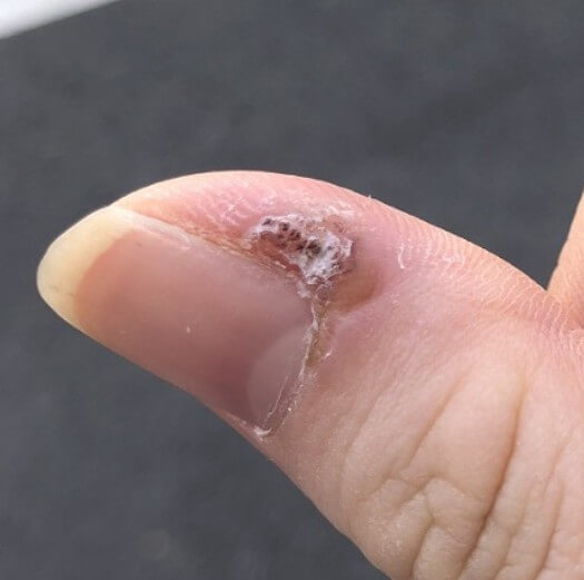  사마귀 종류 및 치료 방법 4가지