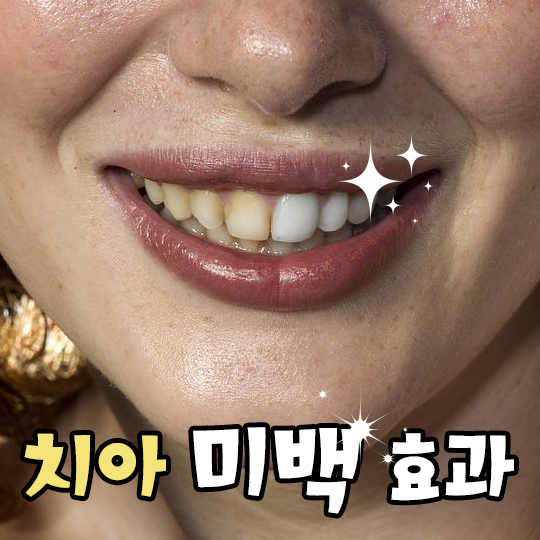 치아미백효과 썸네일