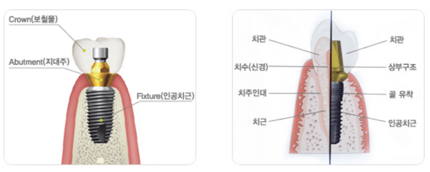 임플란트 가격 비용 비교하기