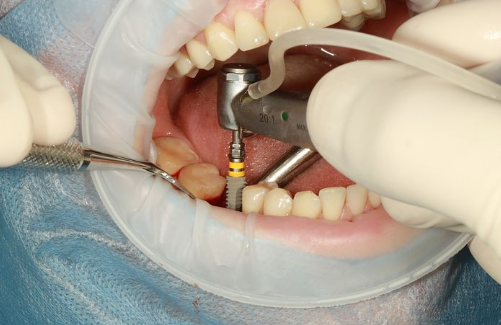 티타늄 임플란트 치료