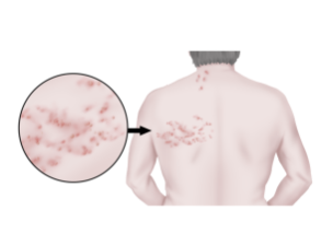대상포진 초기증상