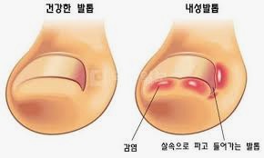  내성발톱, 내성발톱 자가치료, 내성발톱 교정기