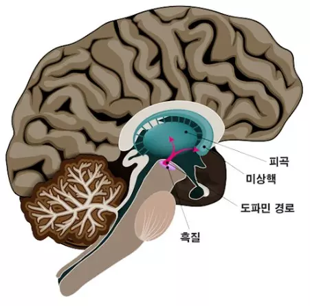 파킨슨병 원인