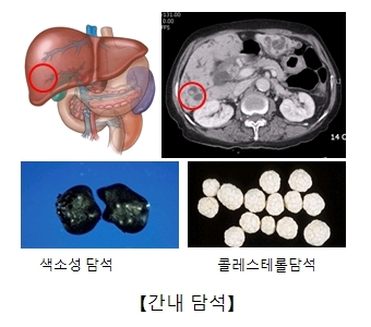 간의 좌엽에서 생기는 짙은 흑갈색을 띄는 색소성 담석과 하얀색 콜레스테롤담석의 색깔과 모양 비교